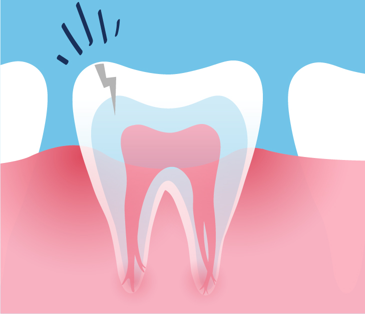 5 Questions To Ask Your Endodontist About Root Canals 